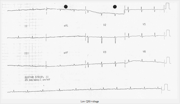 Phức bộ QRS điện áp thấp