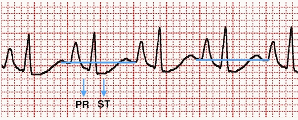 PR và ST chênh xuống dưới đường cơ sở TP