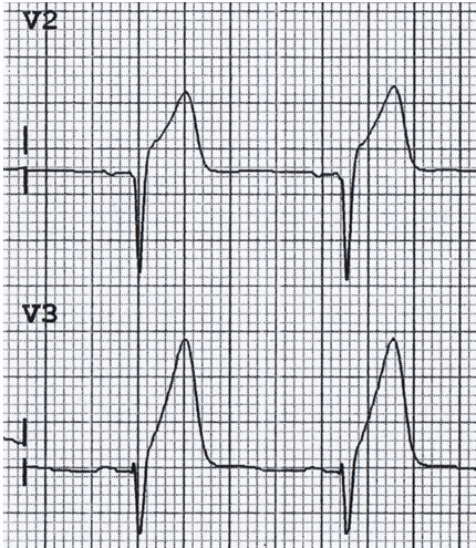 Sóng T hyperacute STEMI thành trước