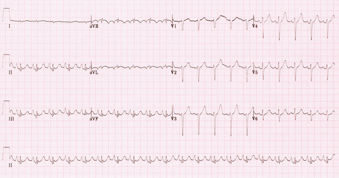 Một ví dụ điển hình của hình bệnh phổi