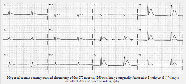 Tăng calci máu gây rút ngắn khoảng QT