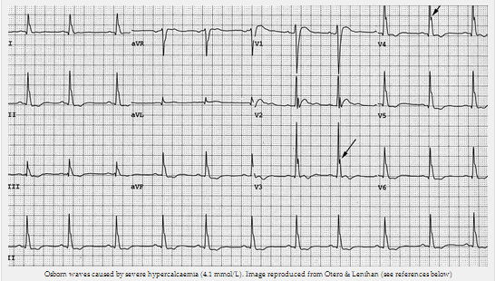 Sóng Osborn do tăng calci máu nặng (4,1 mmol / L)