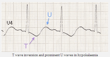 Sóng T đảo ngược và sóng U nổi bật trong hạ kali máu