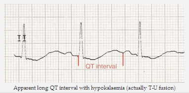 Khoảng QT dài với hạ kali máu (TU hỗ hợp tổng hợp)