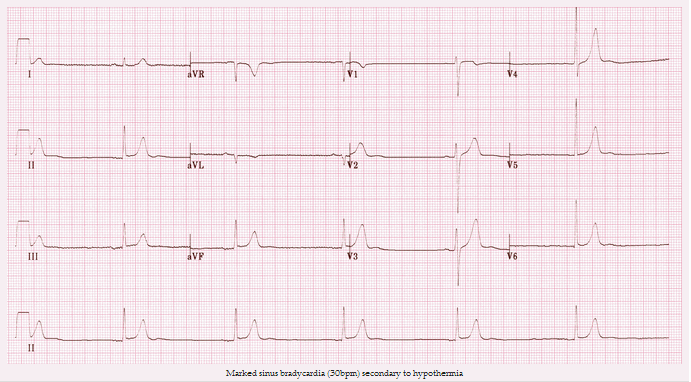 Nhịp tim chậm xoang (30bpm) thứ phát sau hạ thân nhiệt