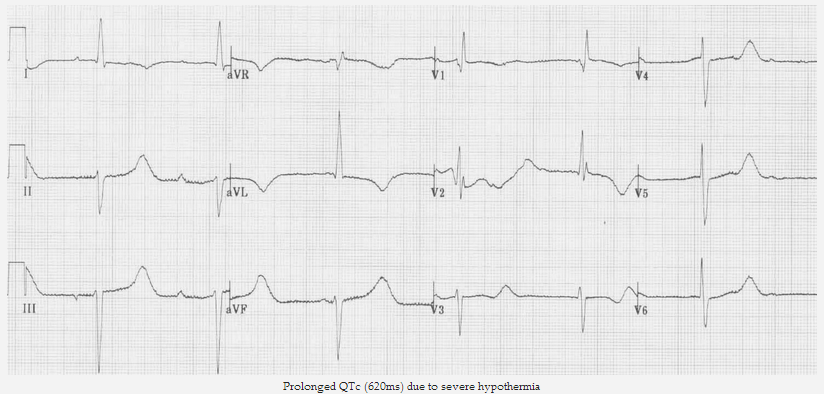 Kéo dài QTc (620ms) do hạ thân nhiệt nghiêm trọng
