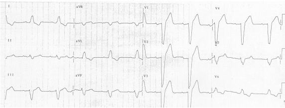 Đảo ngược sóng T do LBBB