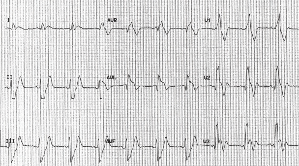 Đảo ngược sóng T sâu trong V1 - 3 với RBBB ở bệnh nhân có PE lớn