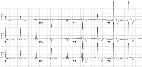 Đảo ngược sóng T trong V1 - 6 do HOCM