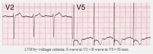 LVH theo các tiêu chí điện áp: sóng S trong V2 + sóng R trong V5 > 35 mm