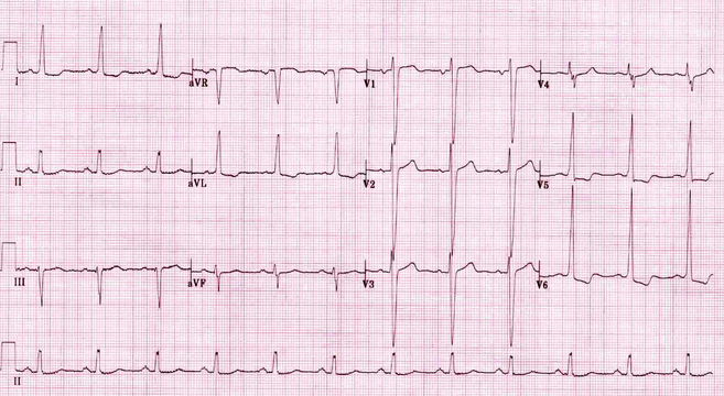 Điện tâm đồ này thể hiện rất nhiều các tính năng của LV phì đại