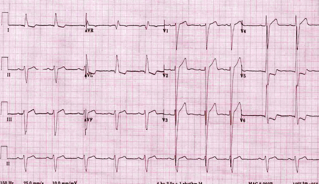 Tăng đáng kể điện áp LV: R đạo trình trước tim rất lớn và sóng S trùng với các đạo trình liền kề