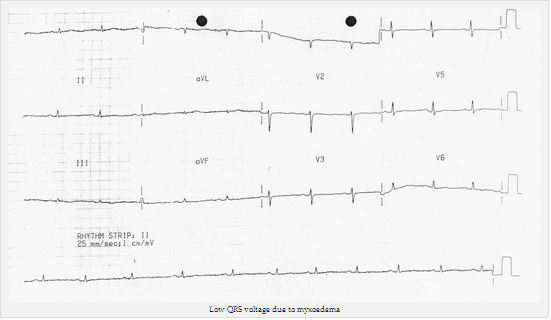 QRS điện áp thấp do Myxoedema