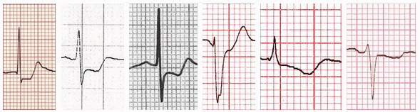 Đoạn ST trong hình thái thiếu máu cục bộ cơ tim