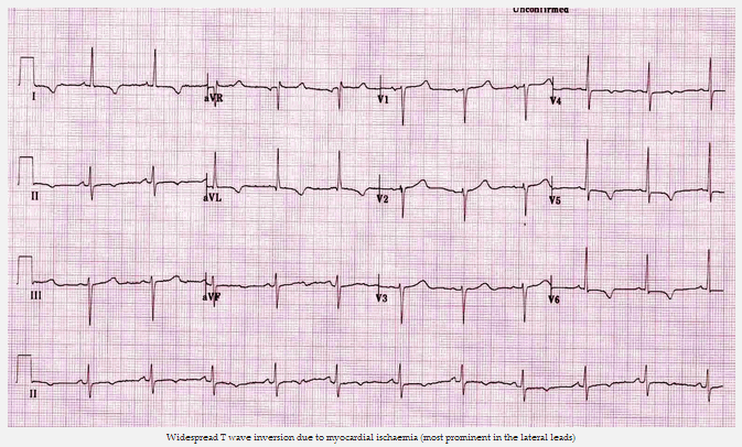 Đảo ngược sóng T phổ biến do thiếu máu cục bộ cơ tim