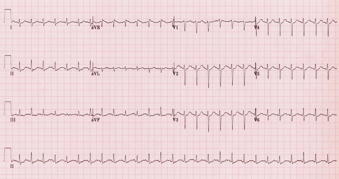 Nhịp tim nhanh xoang với thay đổi đoạn ST không đặc hiệu