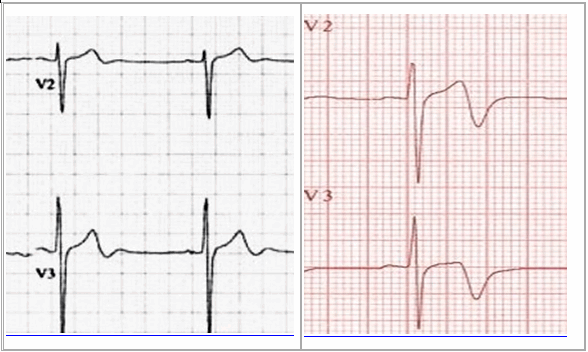 Wellens loại 2