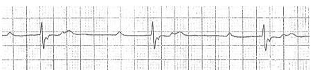 Sóng P ẩn trong block AV độ 2 với dẫn truyền 2:01