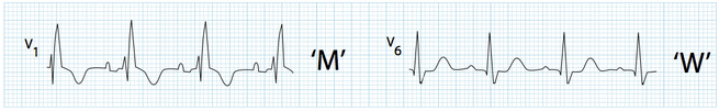 Sóng R’ cao trong V1 (mẫu "M") với S rộng tới V6 (hình "W")