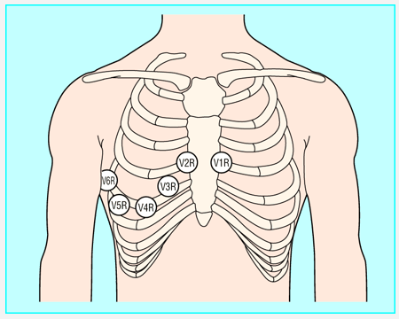 Điện tâm đồ chẩn đoán nhồi máu cơ tim thất phải