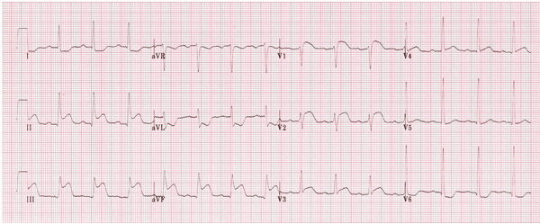 STEMI thành dưới