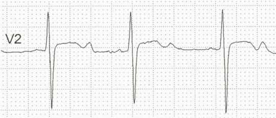 Sóng U nổi bật ở bệnh nhân K+ = 1,9