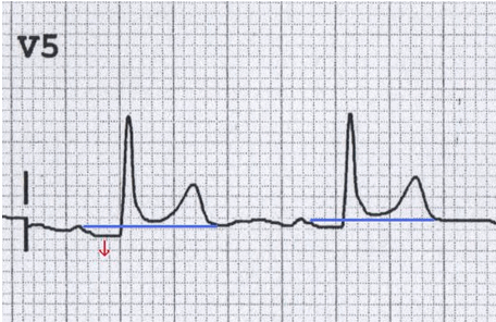 Đoạn PR giảm xuống trong V5 do viêm màng ngoài tim cấp tính (lưu ý cũng có ST cao lõm)
