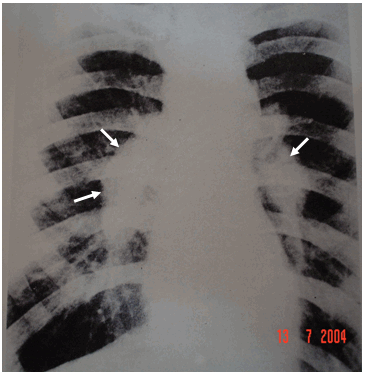 Hình ảnh bụi phổi có các khối silic trong bệnh bụi phổi (Silicosis)