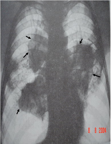 Hình ảnh bệnh bụi phổi Silicosis ở giai đoạn muộn. Các khối silic thường co cụm vào vùng rốn phổi  trên phim dương bản