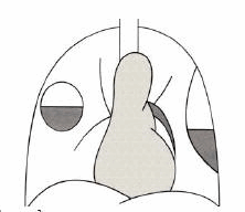Áp xe phổi phải và tràn khí tràn dịch khu trú màng phổi trái