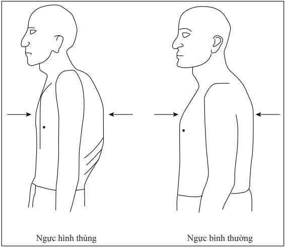 Lồng ngực hình thùng