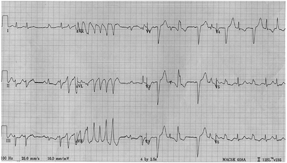 Nhịp tim nhanh thất tự phát đa hình từ hệ thống dẫn truyền mạng Purkinje thất trái
