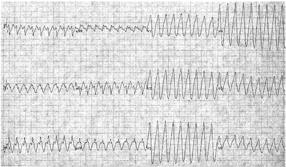 Nhịp tim nhanh vào lại ngược chiều bắt chước nhịp nhanh thất ở bệnh nhân với hội chứng Wolff Parkinson White