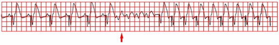 Điện tâm đồ thể hiện nhịp tim nhanh qua trung gian máy điều hòa nhịp tim bắt đầu bởi một bộ ba tâm thất (mũi tên)