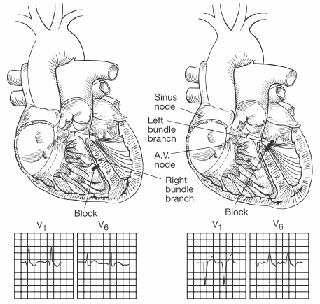 Hình hiển thị vị trí của block nhánh phải đặc trưng ở V1 và V6, điện tâm đồ (ECG) thay đổi với RSR và xuống của sóng S (trái) và block nhánh trái với đặc trưng ECG thay đổi ở V1 và V6, sóng S sâu, rộng, hình QRS rộng (bên phải) trên hình ảnh điện tâm đồ