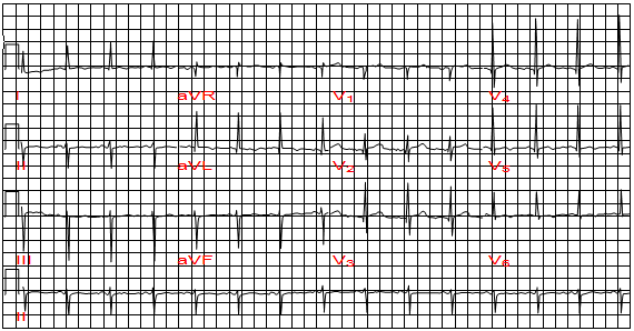 Trục điện tim lệch trái với tăng điện thế ở chuyển đạo aVL, nhưng không phì đại tâm thất trái. Chuyển dịch trục sang trái là do block nhánh trái trước