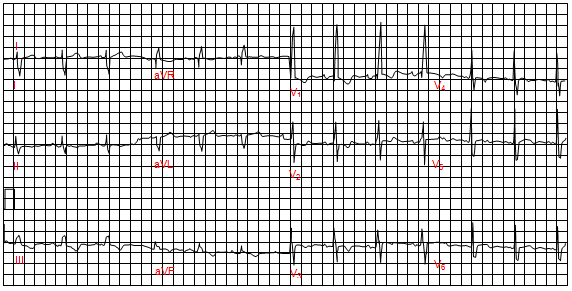 Block nhánh phải với phì đại thất phải (trục điện tim lệch phải, r' ≥ 15 mm ở đạo trình V1)