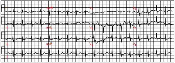 Nhồi máu cơ tim vùng trước bên đã được giải thích như bình thường bởi chương trình máy tính đọc điện tâm đồ