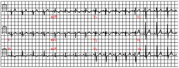 Trục điện tim lệch phải và RSR’ ở V1 dẫn với thời gian < 0,11 thứ phát trong một bé gái 6 tuổi bị khuyết tật thông liên nhĩ lỗ thứ hai.