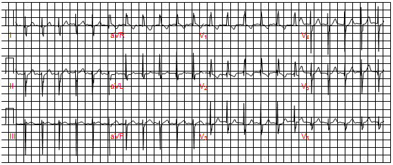 Trục điện tim lệch trái và RSR’ ở V1 dẫn với thời gian < 0,11 lần thứ hai trên bệnh nhân thông liên nhĩ lỗ thứ nhất.