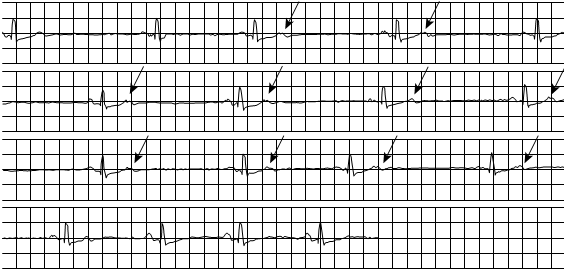 Ngoại tâm thu nhĩ không dẫn (mũi tên) đi thành chùm gây ra nhịp tim chậm trên điện tâm đồ