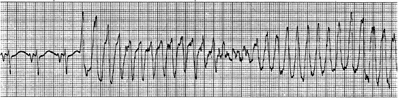 Xoắn đỉnh trên bệnh nhân bị hội chứng QT dài trên hình ảnh điện tâm đồ