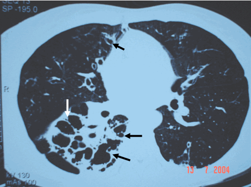 Hình ảnh giãn phế quản phổi phải dạng chùm nho