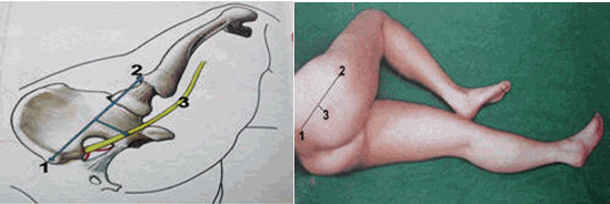 Mốc gây tê dây thần kinh hông