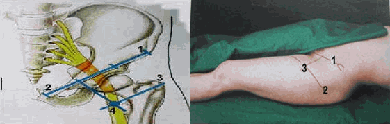 Mốc gây tê thần kinh hông đường ở phía trước