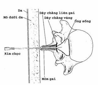 Đường chọc giữa