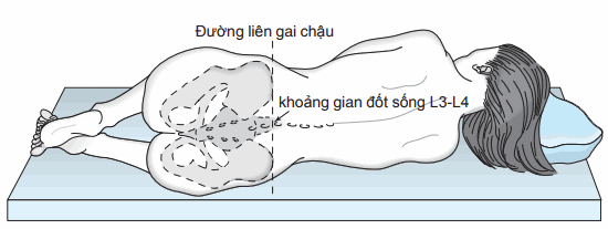 Chọc dò tủy sống