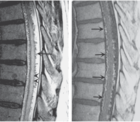 MRI đứng dọc tủy, dị dạng động tĩnh mạch