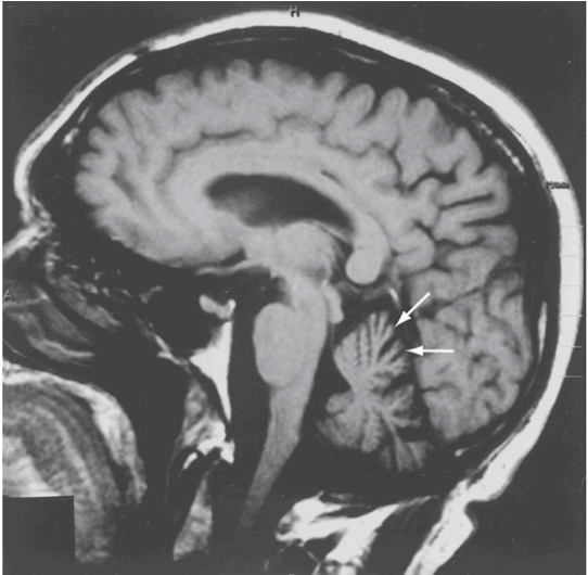 MRI bệnh nhân rối laonj thất điều