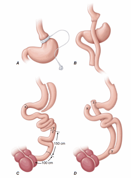 Phẫu thuật giảm cân béo phì